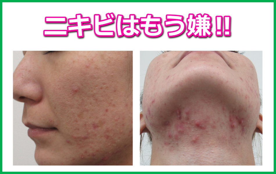 ニキビ 美白 引き締めに